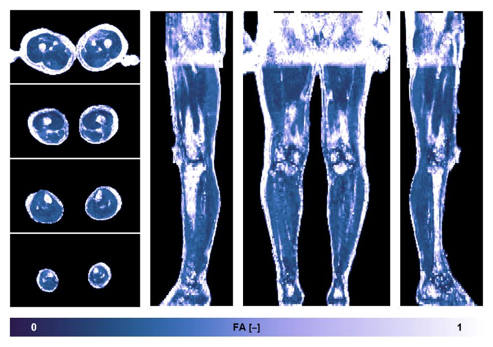 IVIM corrected whole leg muscle fractional anisotropy obtained from diffusion tensor imaging.